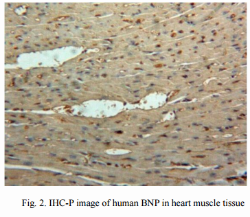 BNP-an Important Biomarker of Heart Failure